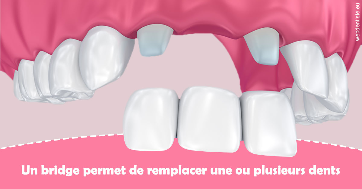 https://www.dr-michel-mahiet.fr/Bridge remplacer dents 2