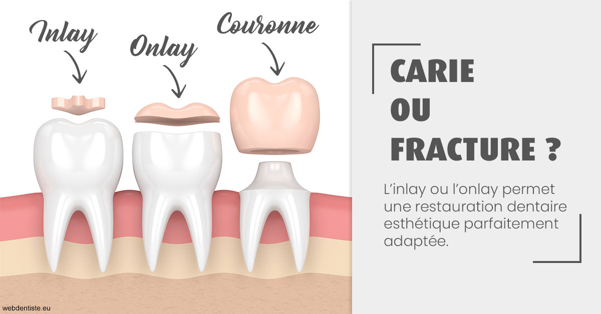 https://www.dr-michel-mahiet.fr/T2 2023 - Carie ou fracture 1