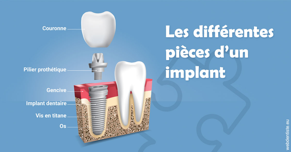 https://www.dr-michel-mahiet.fr/Les différentes pièces d’un implant 1